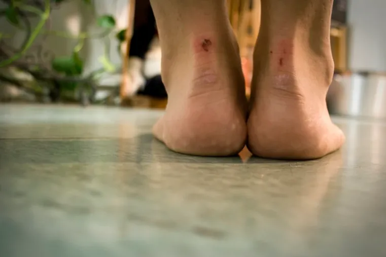 Cómo jugar al fútbol con ampollas y consejos para evitarlas